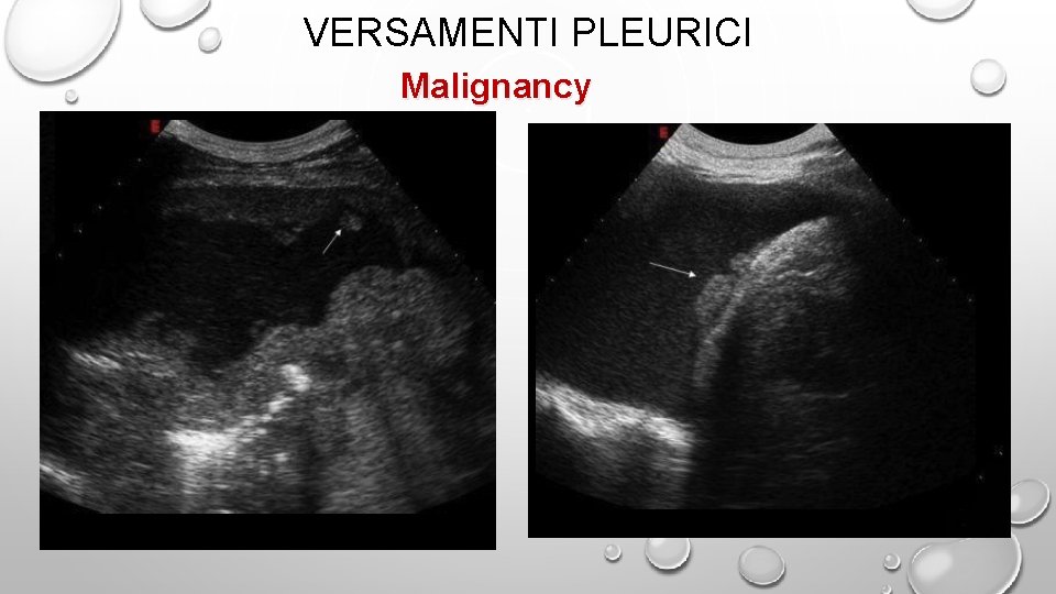 VERSAMENTI PLEURICI Malignancy 