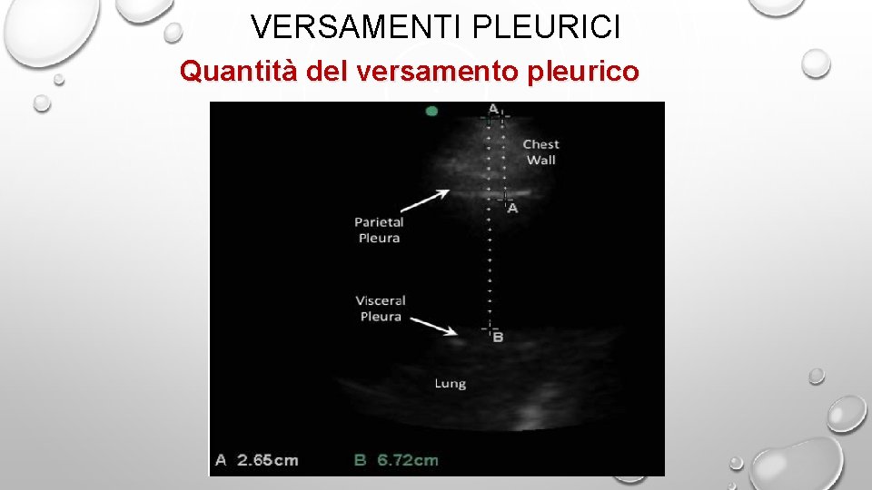 VERSAMENTI PLEURICI Quantità del versamento pleurico 