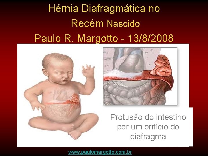 Hérnia Diafragmática no Recém Nascido Paulo R. Margotto - 13/8/2008 Protusão do intestino por Hérnia Diafragmática no Recém Nascido Paulo R. Margotto - 13/8/2008 Protusão do intestino por