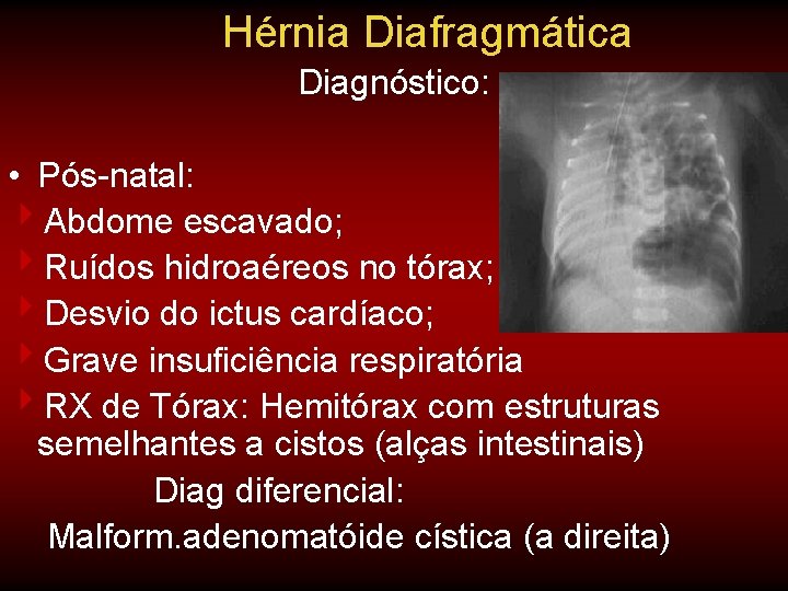 Hérnia Diafragmática Diagnóstico: • Pós-natal: 4 Abdome escavado; 4 Ruídos hidroaéreos no tórax; 4 Hérnia Diafragmática Diagnóstico: • Pós-natal: 4 Abdome escavado; 4 Ruídos hidroaéreos no tórax; 4