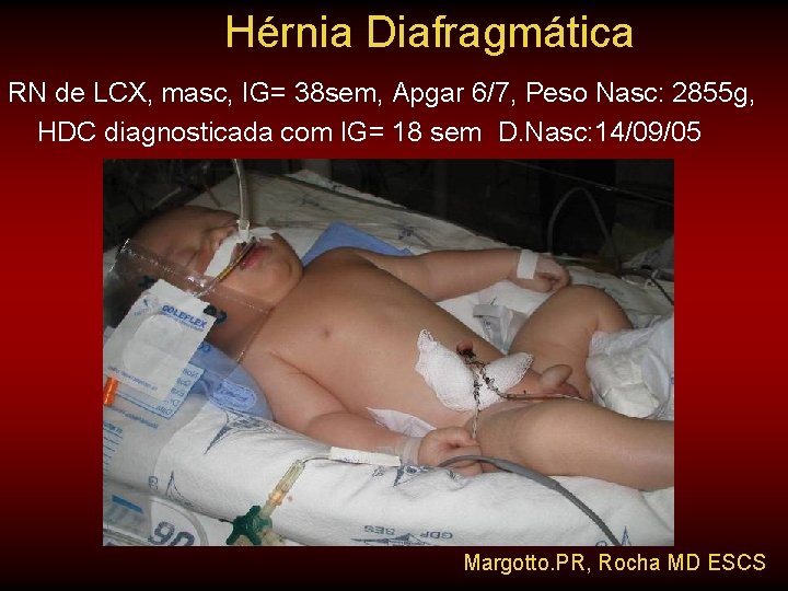 Hérnia Diafragmática RN de LCX, masc, IG= 38 sem, Apgar 6/7, Peso Nasc: 2855 Hérnia Diafragmática RN de LCX, masc, IG= 38 sem, Apgar 6/7, Peso Nasc: 2855