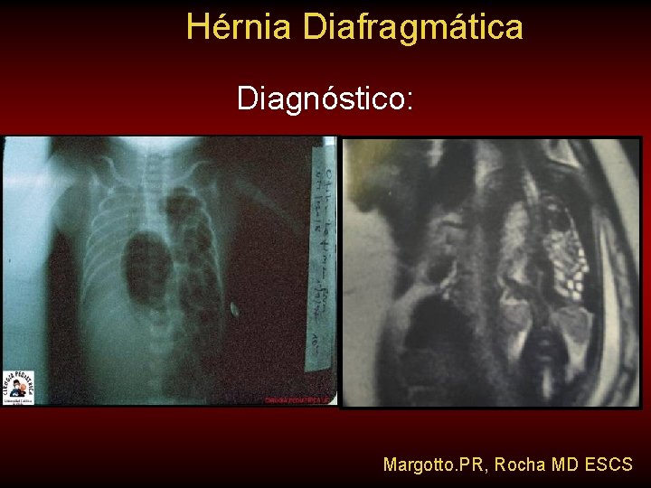 Hérnia Diafragmática Diagnóstico: Margotto. PR, Rocha MD ESCS Hérnia Diafragmática Diagnóstico: Margotto. PR, Rocha MD ESCS