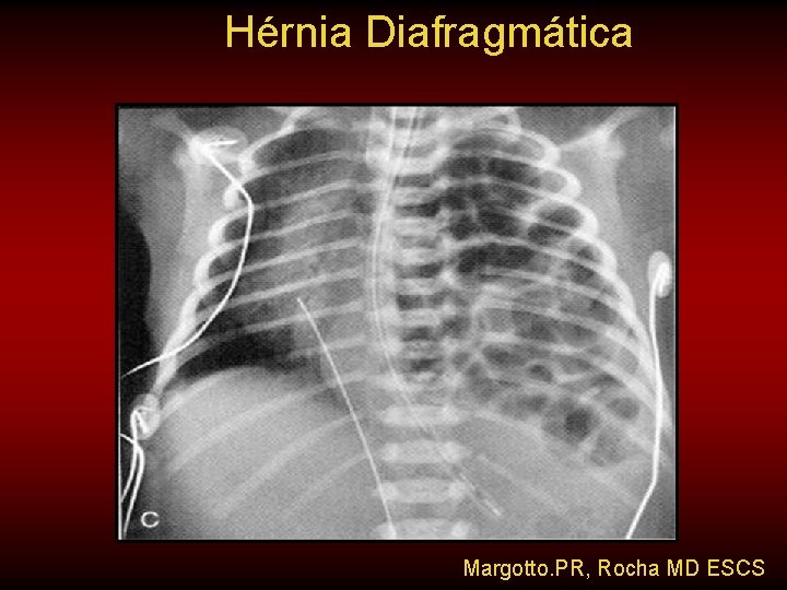 Hérnia Diafragmática Margotto. PR, Rocha MD ESCS 