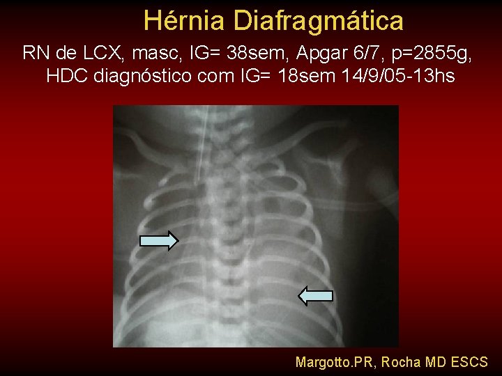 Hérnia Diafragmática RN de LCX, masc, IG= 38 sem, Apgar 6/7, p=2855 g, HDC