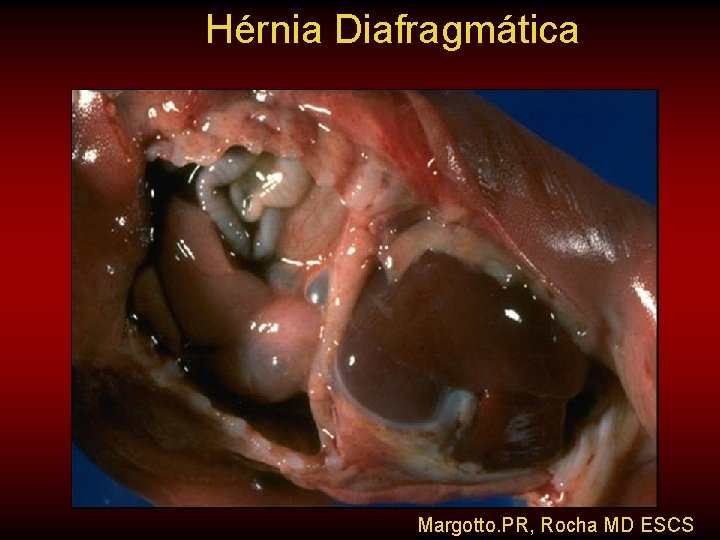 Hérnia Diafragmática Margotto. PR, Rocha MD ESCS 