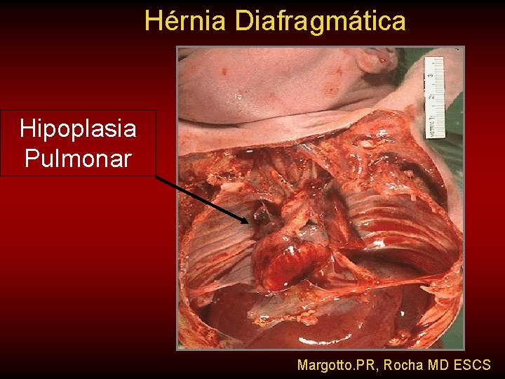 Hérnia Diafragmática Hipoplasia Pulmonar Margotto. PR, Rocha MD ESCS 