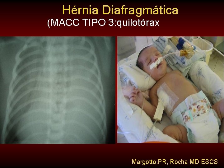 Hérnia Diafragmática (MACC TIPO 3: quilotórax Margotto. PR, Rocha MD ESCS 