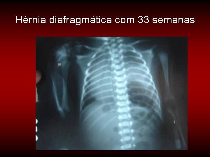 Hérnia diafragmática com 33 semanas Hérnia diafragmática com 33 semanas