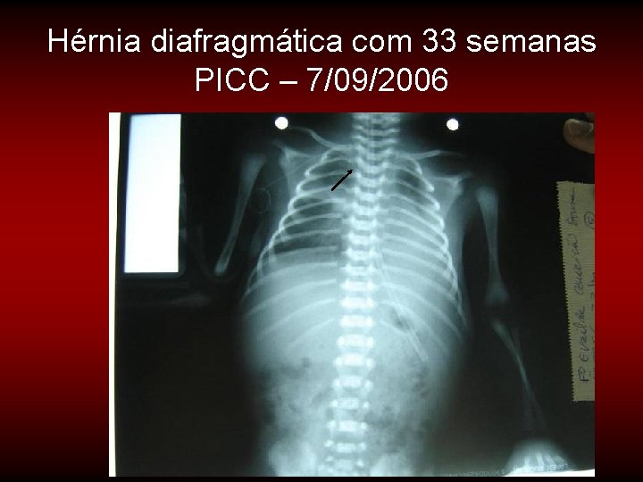 Hérnia diafragmática com 33 semanas PICC – 7/09/2006 