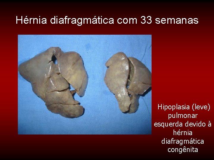 Hérnia diafragmática com 33 semanas Hipoplasia (leve) pulmonar esquerda devido à hérnia diafragmática congênita