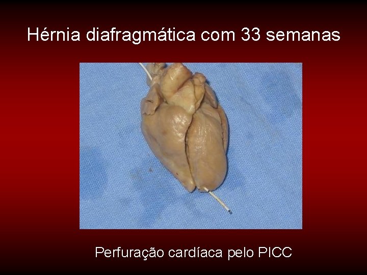 Hérnia diafragmática com 33 semanas Perfuração cardíaca pelo PICC 