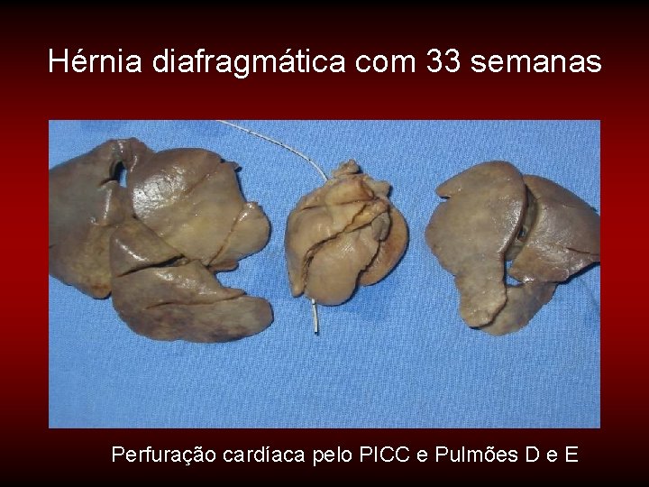 Hérnia diafragmática com 33 semanas Perfuração cardíaca pelo PICC e Pulmões D e E Hérnia diafragmática com 33 semanas Perfuração cardíaca pelo PICC e Pulmões D e E