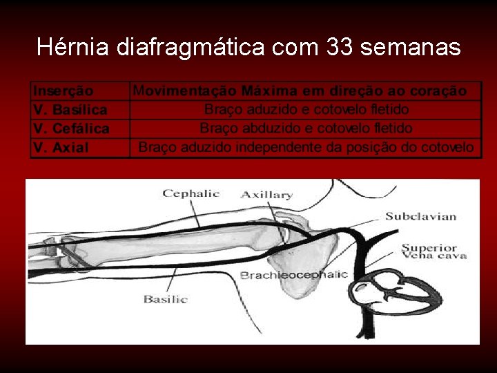 Hérnia diafragmática com 33 semanas 