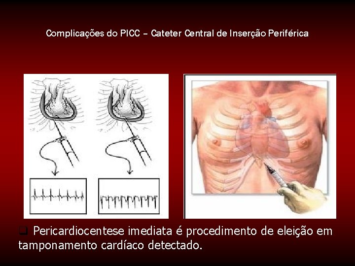 Complicações do PICC – Cateter Central de Inserção Periférica q Pericardiocentese imediata é procedimento