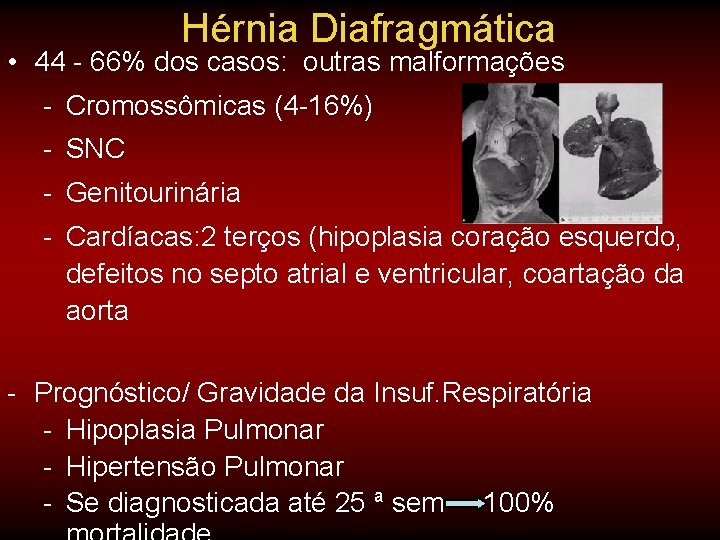 Hérnia Diafragmática • 44 - 66% dos casos: outras malformações - Cromossômicas (4 -16%) Hérnia Diafragmática • 44 - 66% dos casos: outras malformações - Cromossômicas (4 -16%)