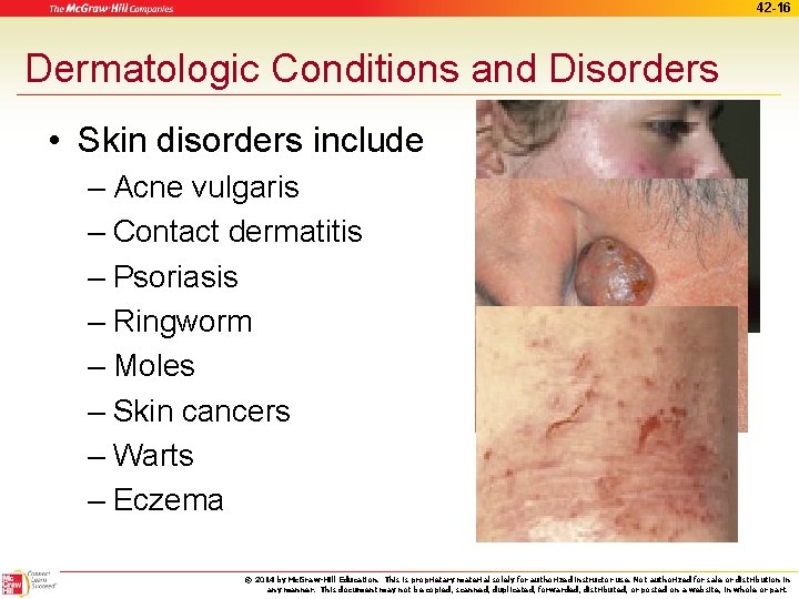 42 -16 Dermatologic Conditions and Disorders • Skin disorders include – Acne vulgaris –