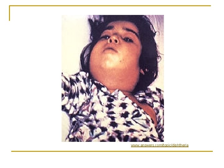 www. answers. com/topic/diphtheria 