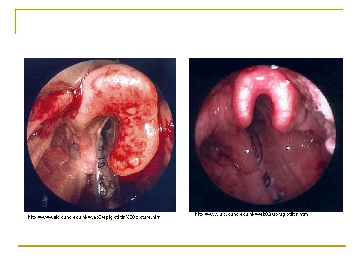 http: //www. aic. cuhk. edu. hk/web 8/epiglottitis%20 picture. htm http: //www. aic. cuhk. edu.