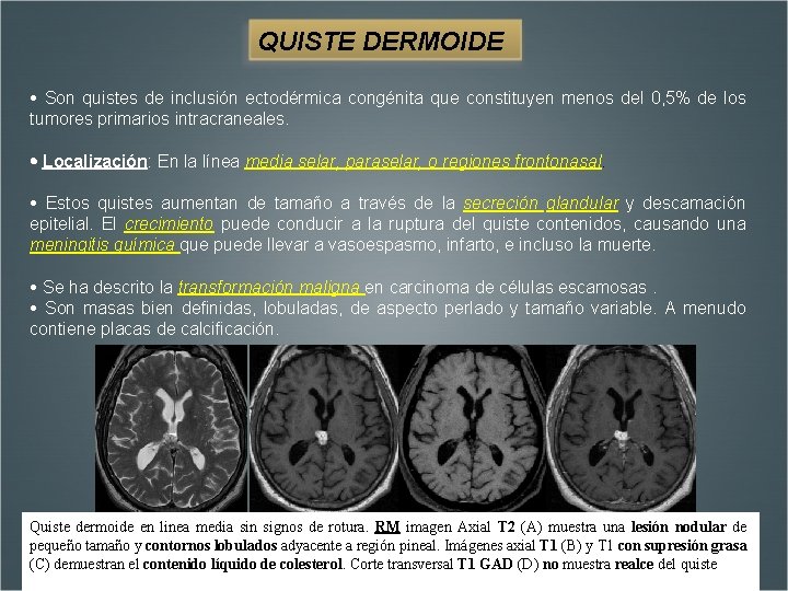 QUISTE DERMOIDE Son quistes de inclusión ectodérmica congénita que constituyen menos del 0, 5%