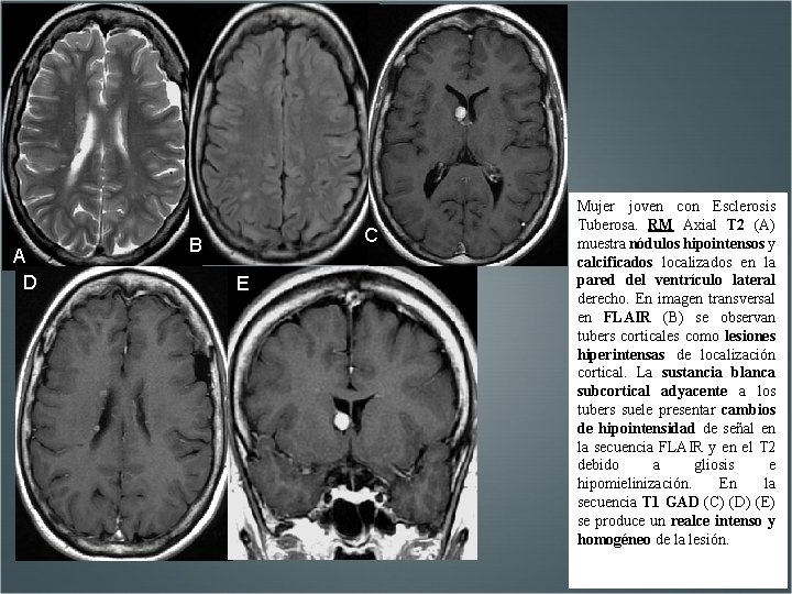 A D C B E Mujer joven con Esclerosis Tuberosa. RM Axial T 2