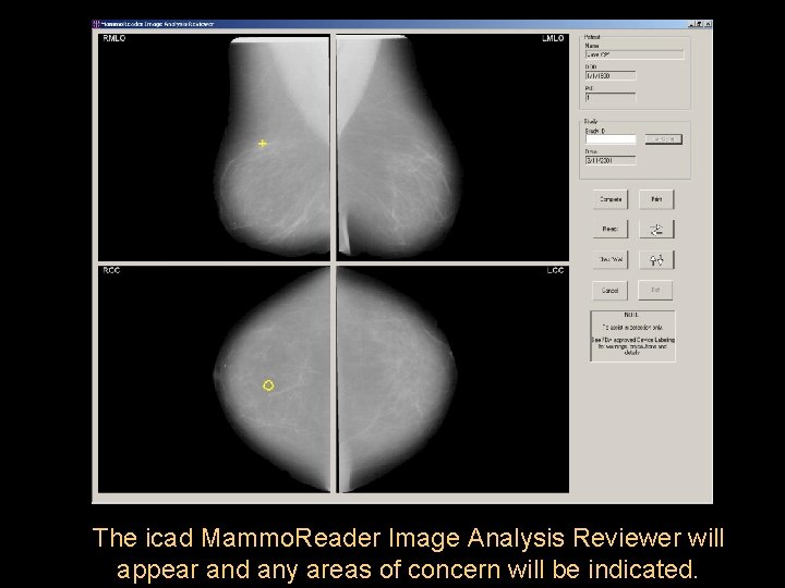 The icad Mammo. Reader Image Analysis Reviewer will appear and any areas of concern