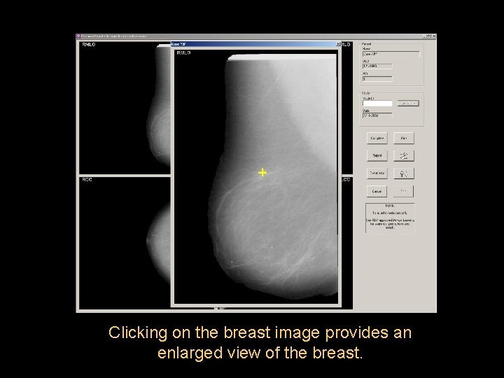 Clicking on the breast image provides an enlarged view of the breast. 