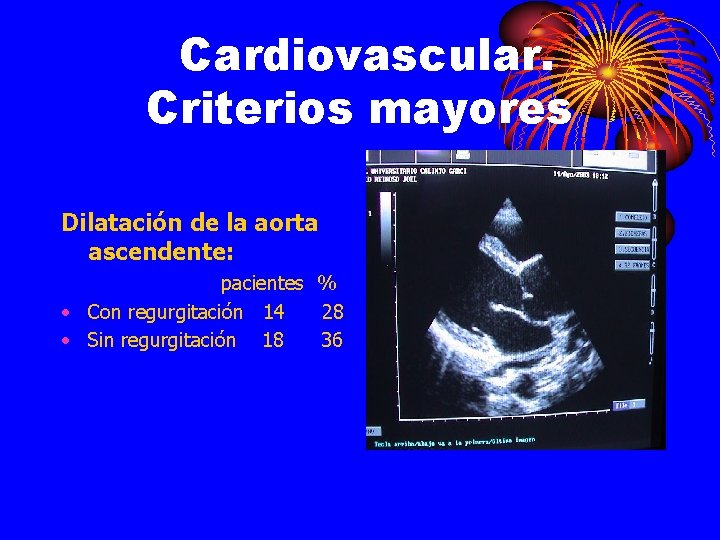 Cardiovascular. Criterios mayores Dilatación de la aorta ascendente: pacientes % • Con regurgitación 14