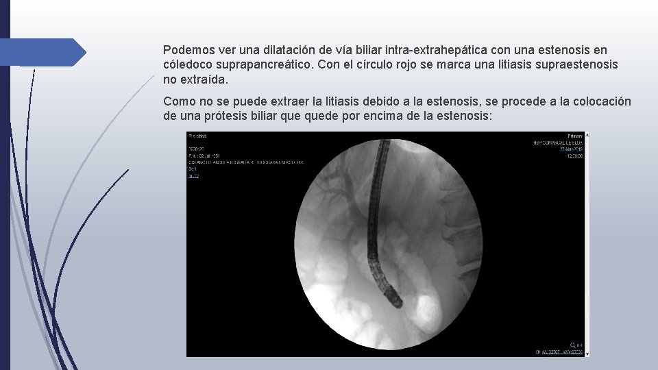 Podemos ver una dilatación de vía biliar intra-extrahepática con una estenosis en cóledoco suprapancreático.