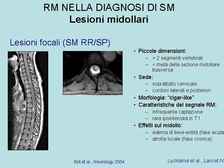 RM NELLA DIAGNOSI DI SM Lesioni midollari Lesioni focali (SM RR/SP) • Piccole dimensioni: