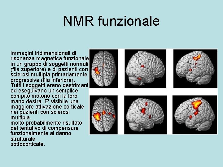 NMR funzionale Immagini tridimensionali di risonanza magnetica funzionale in un gruppo di soggetti normali