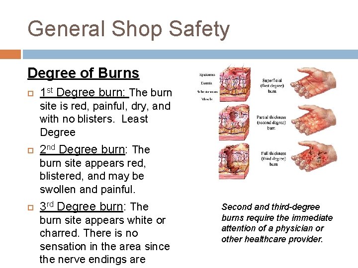 General Shop Safety Degree of Burns 1 st Degree burn: The burn site is