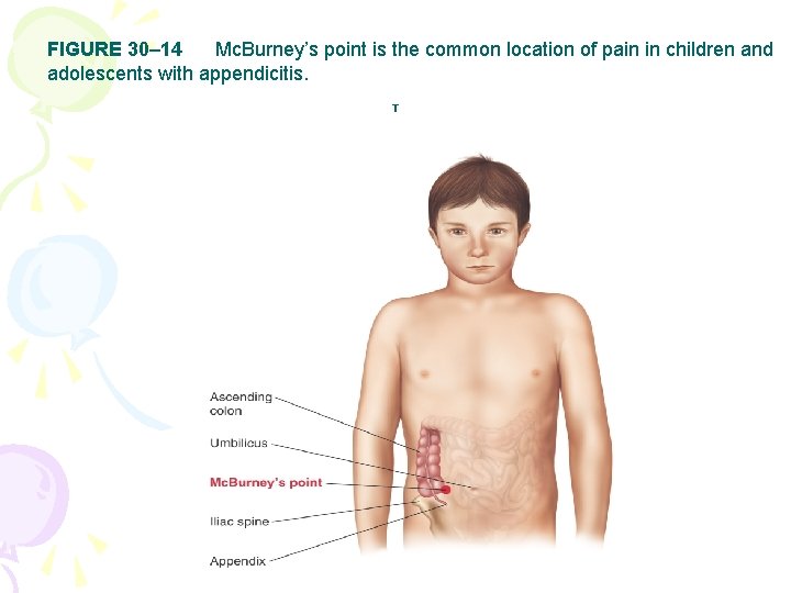 FIGURE 30– 14 Mc. Burney’s point is the common location of pain in children