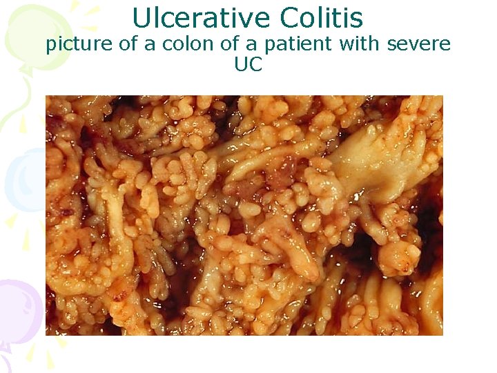 Ulcerative Colitis picture of a colon of a patient with severe UC 
