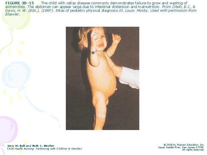 FIGURE 30– 15 The child with celiac disease commonly demonstrates failure to grow and FIGURE 30– 15 The child with celiac disease commonly demonstrates failure to grow and