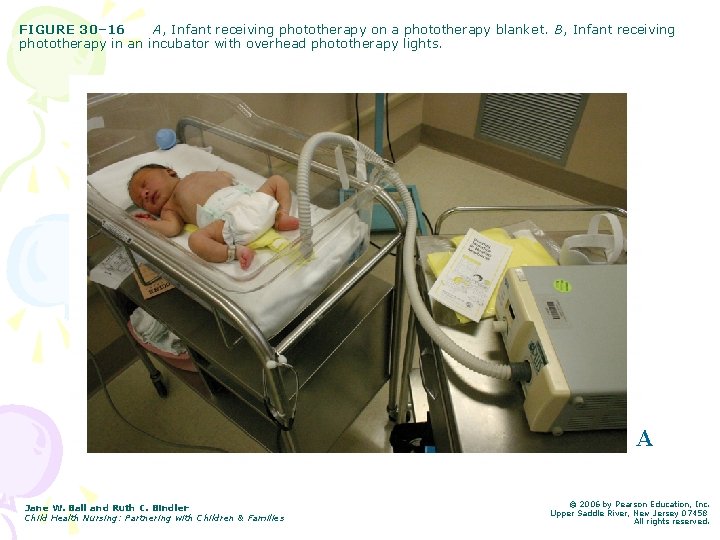 FIGURE 30– 16 A, Infant receiving phototherapy on a phototherapy blanket. B, Infant receiving