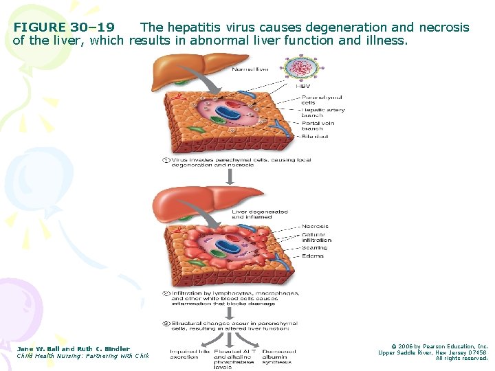 FIGURE 30– 19 The hepatitis virus causes degeneration and necrosis of the liver, which