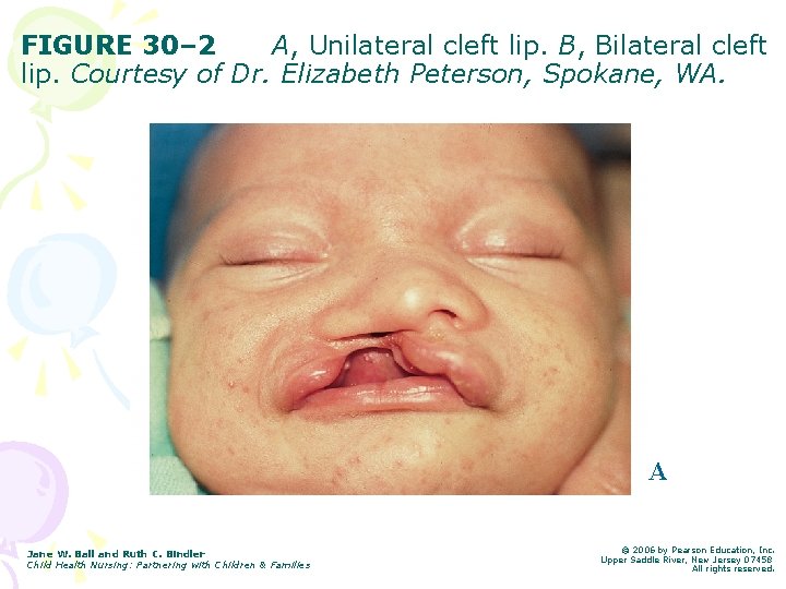 FIGURE 30– 2 A, Unilateral cleft lip. B, Bilateral cleft lip. Courtesy of Dr.
