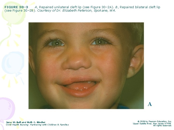 FIGURE 30– 3 A, Repaired unilateral cleft lip (see Figure 30– 2 A). B,