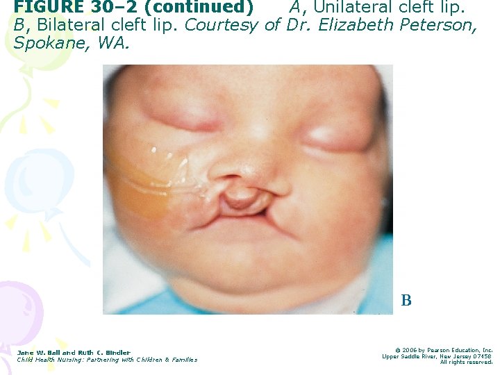 FIGURE 30– 2 (continued) A, Unilateral cleft lip. B, Bilateral cleft lip. Courtesy of