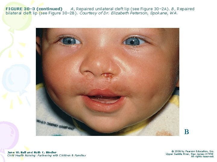 FIGURE 30– 3 (continued) A, Repaired unilateral cleft lip (see Figure 30– 2 A). FIGURE 30– 3 (continued) A, Repaired unilateral cleft lip (see Figure 30– 2 A).
