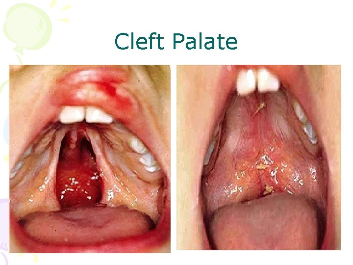 Cleft Palate 