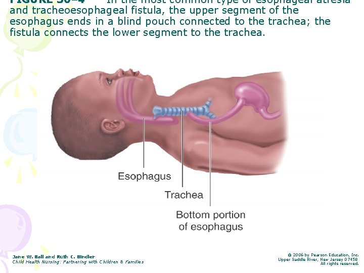 FIGURE 30– 4 In the most common type of esophageal atresia and tracheoesophageal fistula,