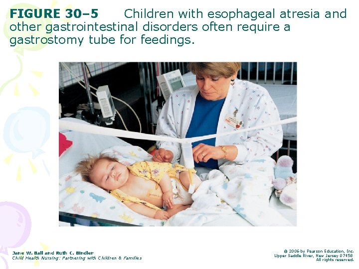 FIGURE 30– 5 Children with esophageal atresia and other gastrointestinal disorders often require a