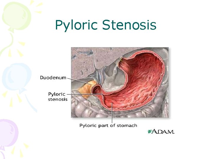 Pyloric Stenosis 