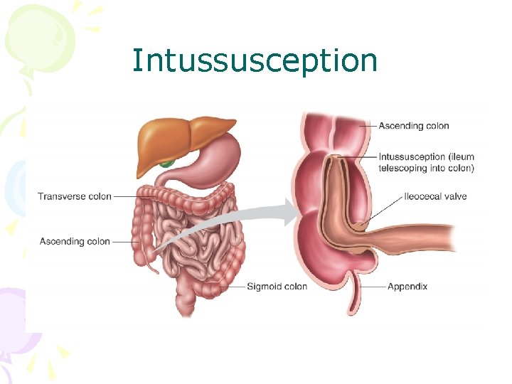 Intussusception 