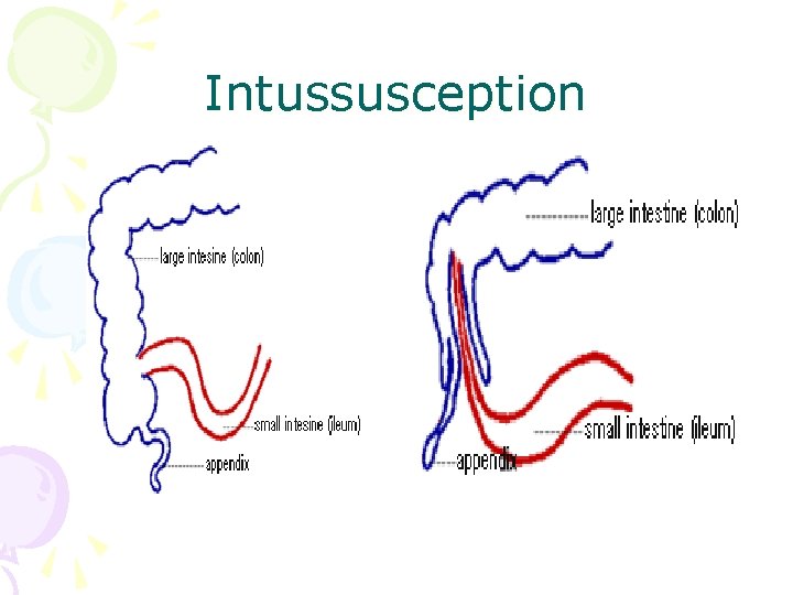 Intussusception 