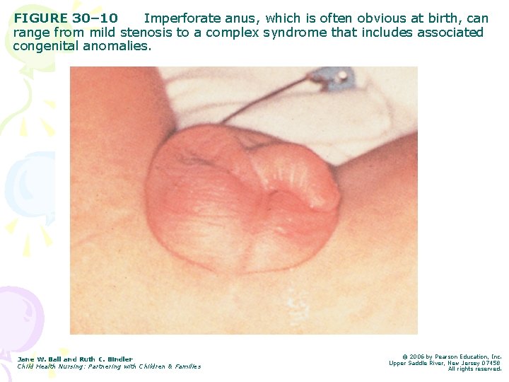 FIGURE 30– 10 Imperforate anus, which is often obvious at birth, can range from