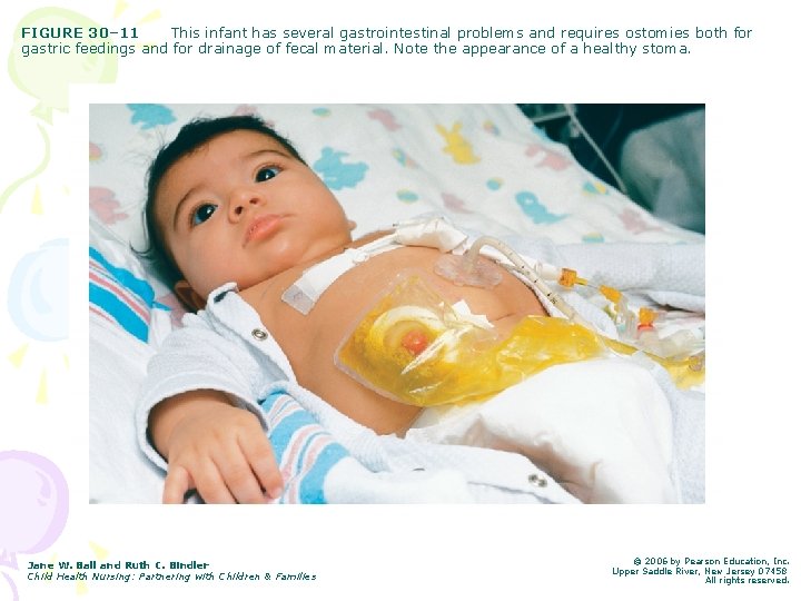 FIGURE 30– 11 This infant has several gastrointestinal problems and requires ostomies both for