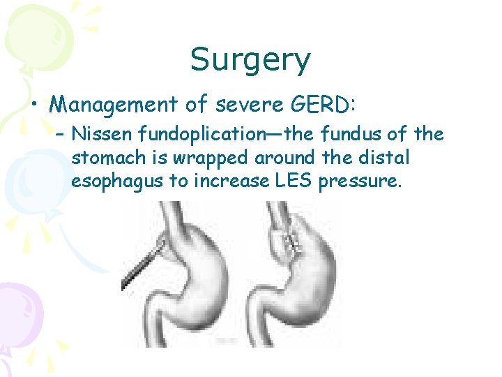 Surgery • Management of severe GERD: – Nissen fundoplication—the fundus of the stomach is