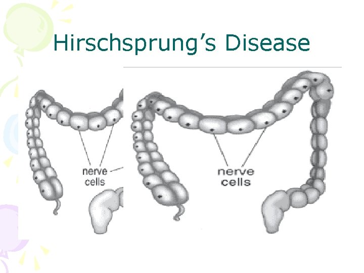 Hirschsprung’s Disease 
